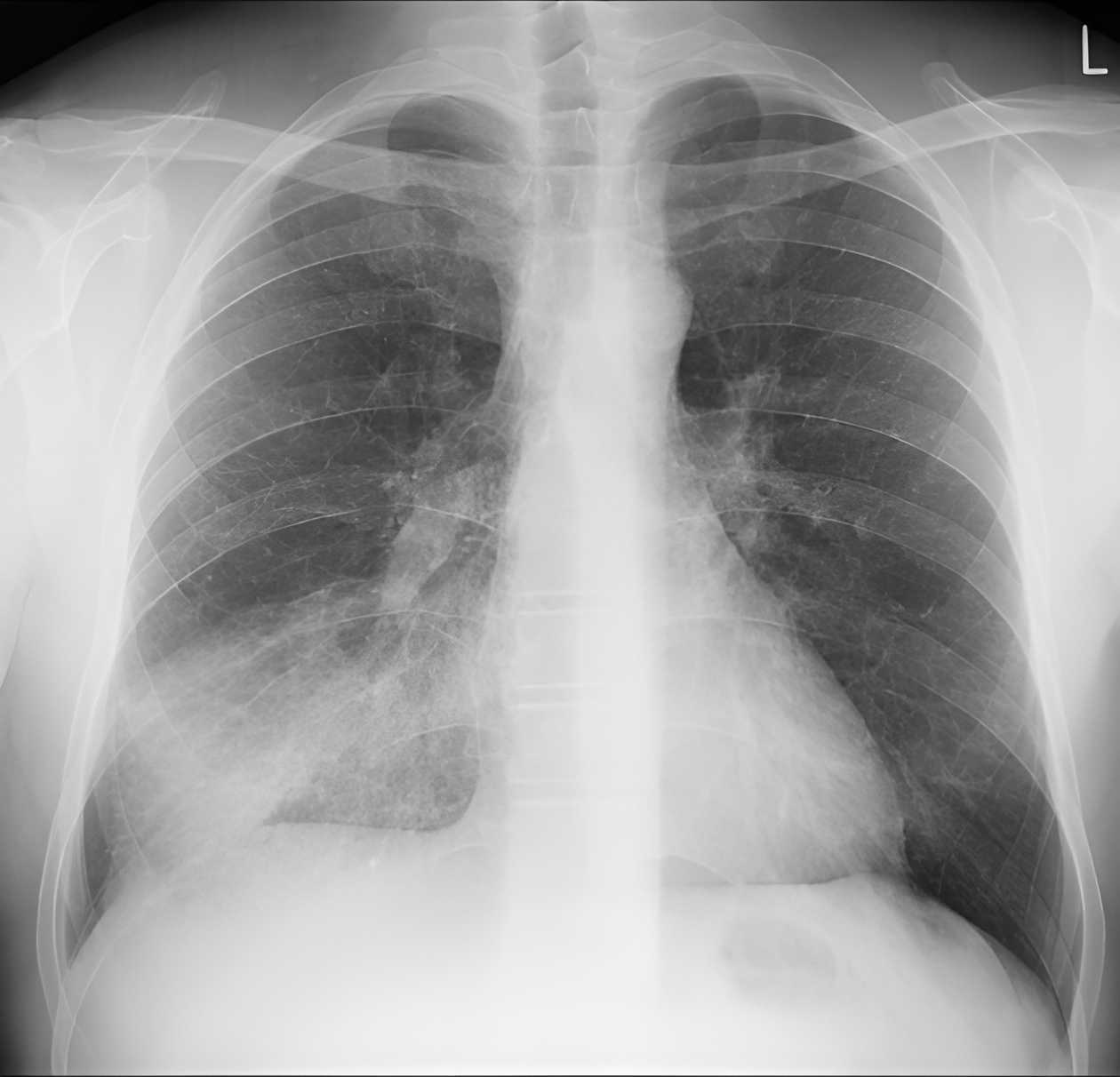 Elementos para identificar neumonía en una radiografía de tórax ...